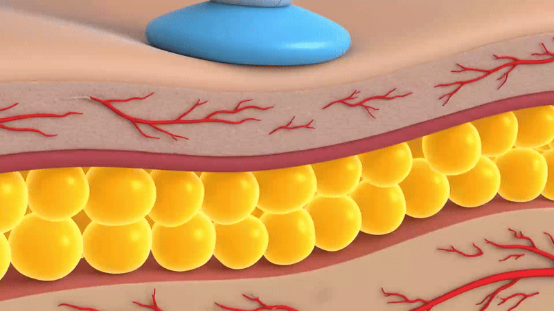 레이저 원리 이미지