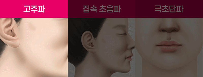 리프팅 원리 비교