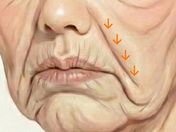 위에서 눌러오는 처진 지방