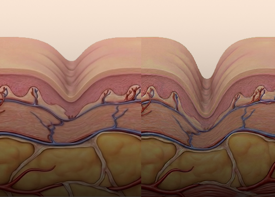 얇은 주름부터 깊은 주름까지