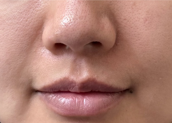 팔자주름 시술 전