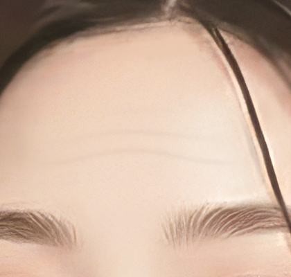 이마 문제 개선